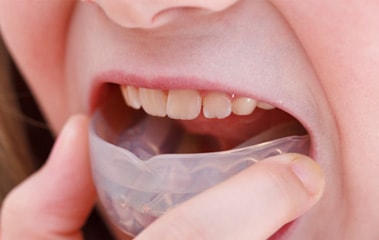 歯列矯正用咬合誘導装置（ムーシールド）による幼児期の矯正治療